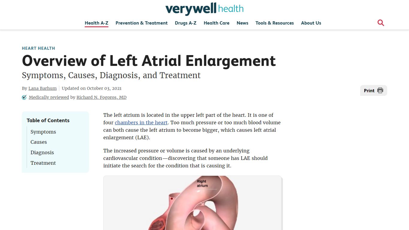 Left Atrial Enlargement: Symptoms, Causes, and Treatment - Verywell Health